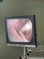 

В ДГКБ № 5 им. Н. Ф. Филатова начали проводить лапароскопическое лечение диафрагмальных  грыж рисунок
