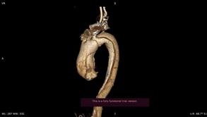 

Врачи впервые провели операцию по линейному протезированию восходящего отдела и дуги аорты в Елизаветинской больнице рисунок
