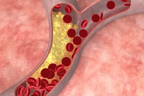 

Информация для тех, кто страдает тяжелой гиперхолестеринемией рисунок
