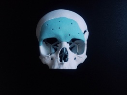 

В ДГБ № 5 им. Н. Ф. Филатова состоялась уникальная операция по исправлению дефекта черепа при помощи специального материала гидроксиапатита рисунок
